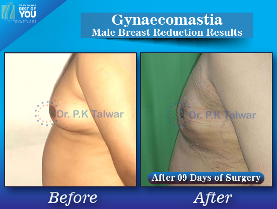 Gynaecomastia before after image